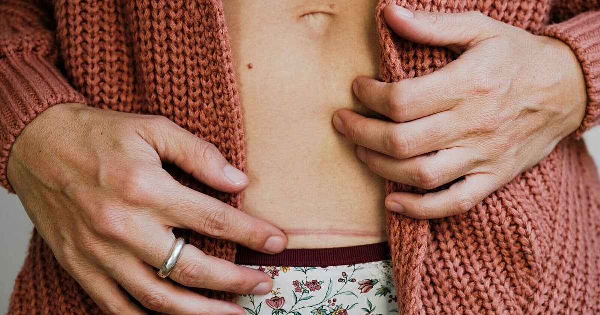 Worauf-es-bei-der-Pflege-von-Narben-ankommt