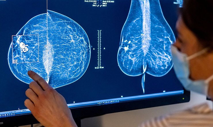Für Frauen gibt es eine spezielle Untersuchung, um Krebs früh zu entdecken: die Mammografie. (Archivbild) - © Hannibal Hanschke/dpa
