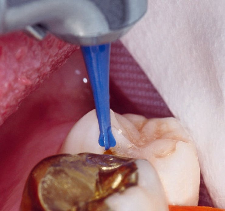 Lemgoer Gebr. Brasseler entwickeln neues Medizinprodukt Lokale