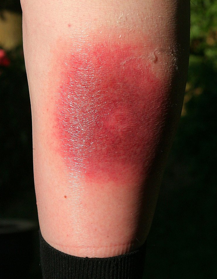 Klares Warnzeichen für Borreliose: Die sogenannte Wanderröte kann Tage oder Wochen nach einem Zeckenstich auftreten. (Archivbild) - © Harry Melchert/dpa/dpa-tmn