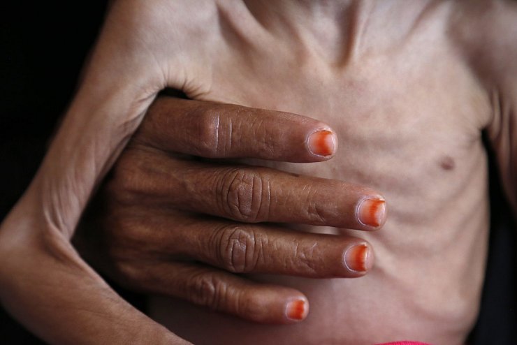 Friedensnobelpreis f&uuml;r das Weltern&auml;hrungsprogramm - &copy; Foto: Mohammed Mohammed/XinHua/dpa