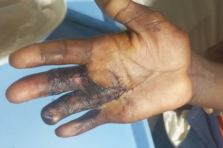 In Afrika wird &uuml;berwiegend mit offenem Feuer und hei&szlig;em &Ouml;l gekocht. Vor allem Kinder und Kleinstkinder erleiden h&auml;ufig schwerste Verbrennungen, die nicht behandelt werden. - &copy; Nikolaus von Braunm&uuml;hl