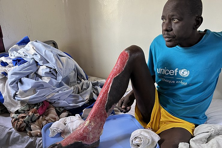 In Afrika wird &uuml;berwiegend mit offenem Feuer und hei&szlig;em &Ouml;l gekocht. Vor allem Kinder und Kleinstkinder erleiden h&auml;ufig schwerste Verbrennungen, die nicht behandelt werden. - &copy; Nikolaus von Braunm&uuml;hl