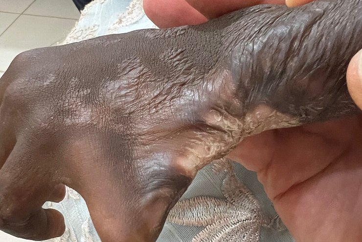 In Afrika wird &uuml;berwiegend mit offenem Feuer und hei&szlig;em &Ouml;l gekocht. Vor allem Kinder und Kleinstkinder erleiden h&auml;ufig schwerste Verbrennungen, die nicht behandelt werden. - &copy; Nikolaus von Braunm&uuml;hl