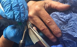 Gebrochener Finger wird einem Salzufler zum Verhängnis. - Feuerwehr Bad Salzuflen