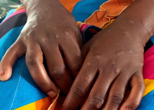 Mpox ist vor allem für kleine Kinder und immungeschwächte Menschen gefährlich (Archivbild) - © Janvier Barhahiga/AP/dpa