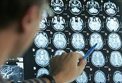 Arzt beurteilt Gehirnquerschnitte einer Schlaganfall-Patientin - Friso Gentsch/dpa/dpa-tmn
