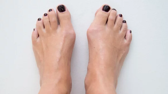 Wer einen Ballenzeh Hallux valgus hat, erkennt das unter anderem am Köpfchen des Mittelfußknochens. Es tritt bei der Fehlstellung oft stark an der Fußinnenseite vor. - © Andrea Warnecke/dpa-tmn