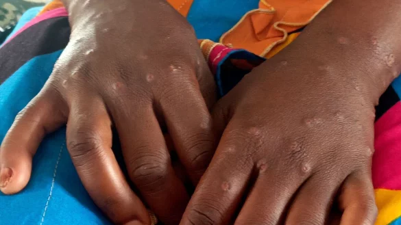 Mpox ist vor allem für kleine Kinder und immungeschwächte Menschen gefährlich (Archivbild) - © Janvier Barhahiga/AP/dpa