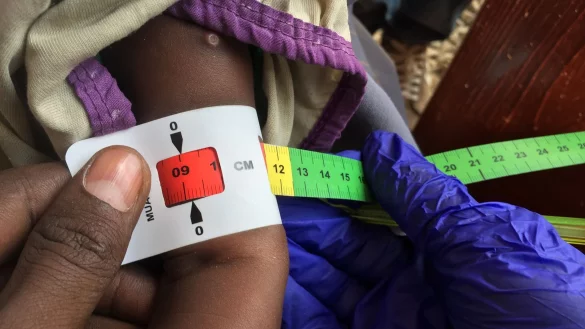 Ein Arzt misst im Sudan den Armumfang eines schwer unterernährten Babys (Archivbild) - © Eva-Maria Krafczyk/dpa