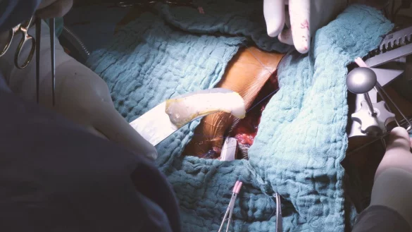 Bei einer Operation setzen Ärzte ein «Herzpflaster» ein. - © Universitätskrankenhaus Schleswig-Holstein/dpa