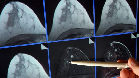 Im Zuge des Mammographie-Screening-Programms können Frauen alle zwei Jahre eine Röntgen-Untersuchung der Brust zur Früherkennung in Anspruch nehmen. (Archivbild) - © Jan-Peter Kasper/dpa-Zentralbild/dpa