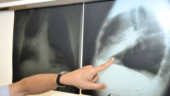 Ein Arzt zeigt auf ein Röntgenbild von einer von Krebs befallenen Lunge. (Illustration) - © Felix Hörhager/dpa