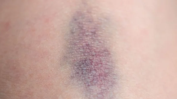 Wenn bereits leichte St&ouml;&szlig;e h&auml;ufig zu blauen Flecken f&uuml;hren, kann das auf eine St&ouml;rung der Blutgerinnung hinweisen. - &copy; Andrea Warnecke/dpa-tmn