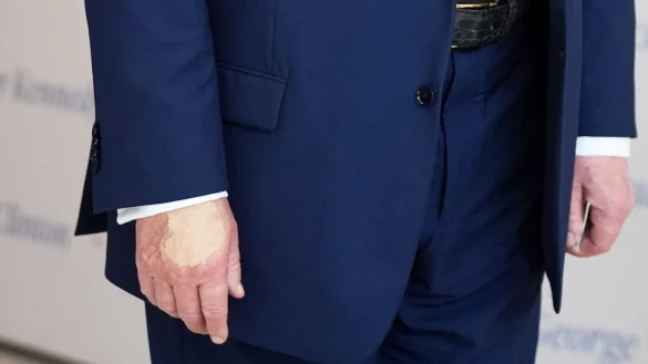 Für Trump ein unliebsames Thema: die überschminkte Hand (Archivbild). - © Evan Vucci/AP/dpa