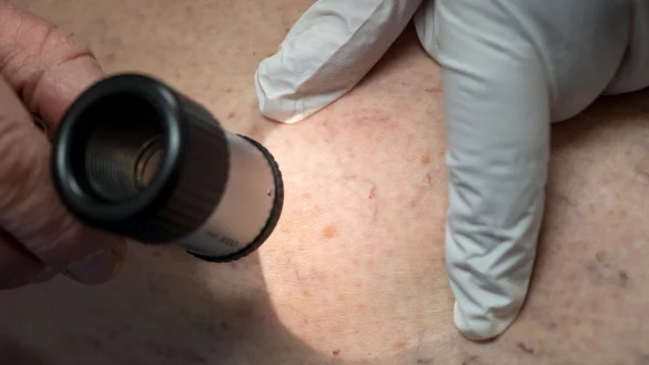 Die Zahl der Krankenhausbehandlungen von Hautkrebs stieg enorm an. (Symbolbild) - © Peter Kneffel/dpa