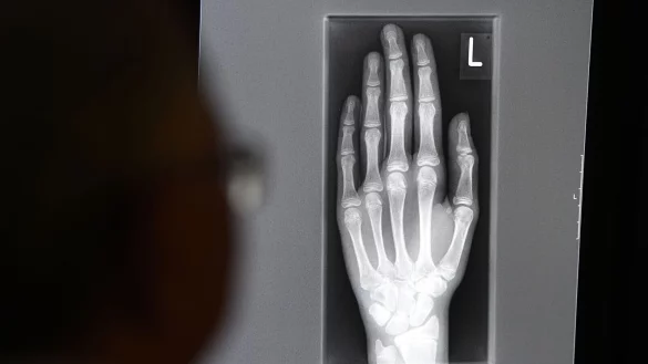 Ein Röntgenbild auf einem Bildschirm zeigt in einem Klinikum in Baden-Württemberg die linke Hand eines jungen Menschen im Alter zwischen 16 und 19 Jahren. - © Felix Kästle/dpa