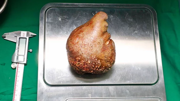 Das Foto zeigt den Nierenstein auf einer Waage. - &copy; Sri Lanka Army/dpa