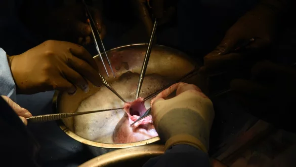 Chirurgen f&uuml;hren die Transplantation des Schweineherzens im Krankenhaus in Baltimore durch. - &copy; Mark Teske/University of Maryland School of Medicine/dpa