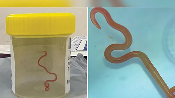 Der lebende Spulwurm &laquo;Ophidascaris robertsi&raquo; wurde im Gehirn einer 64-j&auml;hrigen Australierin gefunden. - &copy; Emerging Infectious Diseases/AAP/dpa