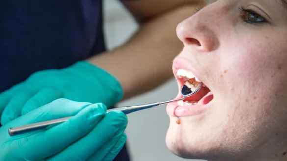 Ver&auml;nderungen der Mundschleimhaut k&ouml;nnen Symptome einer solchen Erkrankung sein. - &copy; Christin Klose/dpa-tmn