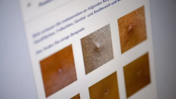 Wer die PoxApp aufruft, wird zuerst anhand von Bildern gefragt, ob die eigenen Hautver&auml;nderungen so &auml;hnlich aussehen. - &copy; Zacharie Scheurer/dpa-tmn