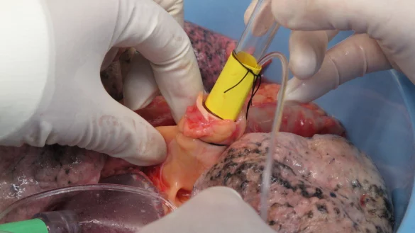 Nach einer Lungentransplantation ist eine Französin schwer erkrankt. - © picture alliance / AP Images (Symbolbild)