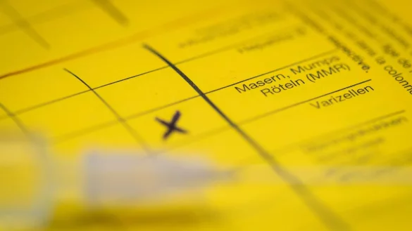 Bei Masern zeigt sich erst oft Fieber, bevor sp&auml;ter ein Hautausschlag dazukommt. (Symbolbild) - &copy; Friso Gentsch/dpa