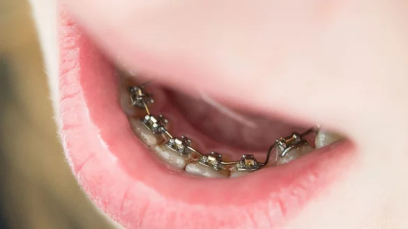 Gegen schiefe Z&auml;hne hilft eine Zahnspange. - &copy; Franziska Gabbert/dpa