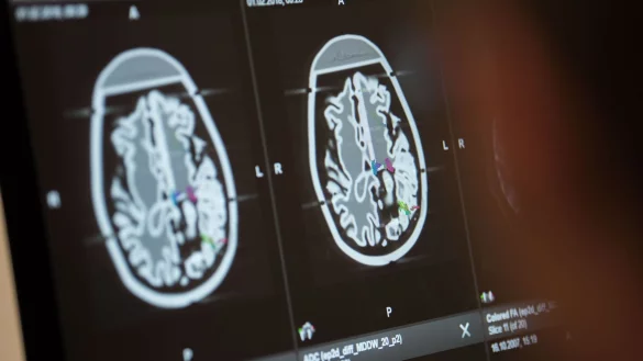 Die Fallzahlen f&uuml;r Erkrankungen des Nervensystems sind weltweit deutlich gestiegen. - &copy; Lino Mirgeler/dpa