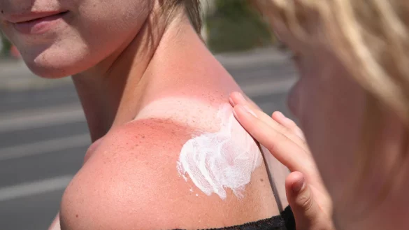 Zu viel Sonne auf die Schultern bekommen? Dann helfen K&uuml;hlung und eine beruhigende Hautpflege. - &copy; Stephanie Pilick/dpa/dpa-tmn