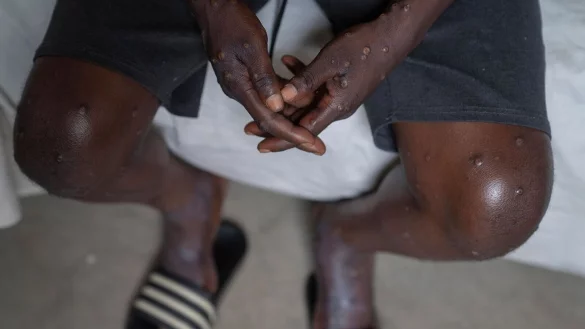 Mehrere Mpox-Ausbrüche in Afrika und eine neue womöglich gefährliche Variante bedrohen die öffentliche Gesundheit weltweit. (Archivbild) - © Moses Sawasawa/AP