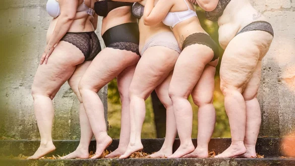 Frauen mit Lip&ouml;dem-Erkrankung. Betroffene k&auml;mpfen f&uuml;r eine Ent-Stigmatisierung der Krankheit und fordern mehr kompetente &Auml;rzte. - &copy; Carina Gorny Fotografie/Lip&ouml;dem-Gesellschaft/dpa