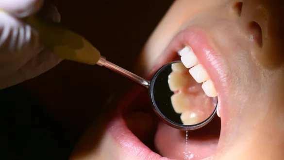 Fluoridlack soll die Z&auml;hne vor Karies sch&uuml;tzen. Seit dem 24. April 2024 haben nun alle Kinder unter sechs Jahren unabh&auml;ngig vom Kariesrisiko einen Anspruch auf diese Leistung. - &copy; Julian Stratenschulte/dpa