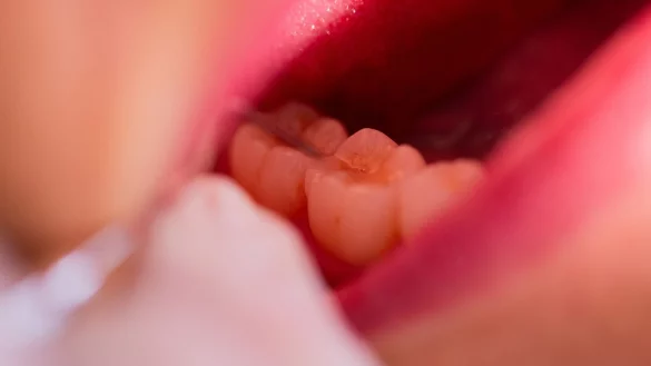 Nach dem der Arzt den Patienten r&ouml;ntgte, stellt er seinen Fehler fest und fuhr ihn selbst in eine Klinik (Symbolbild). - &copy; Rolf Vennenbernd/dpa