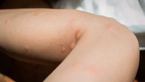 Richtig zerstochen: Von M&uuml;ckenstichen die Finger zu lassen, das ist alles andere als leicht. - &copy; Karolin Kr&auml;mer/dpa-tmn