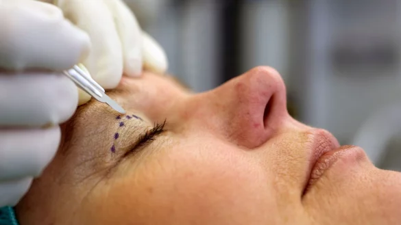 Sch&ouml;nheits-OPs im Ausland sind beliebt: Doch deutsche Krankenkassen &uuml;bernehmen meist keine Folgekosten f&uuml;r misslungene Eingriffe, weshalb sorgf&auml;ltige Auswahl und eine gute Absicherung entscheidend sind. - &copy; Jens Schierenbeck/dpa-tmn