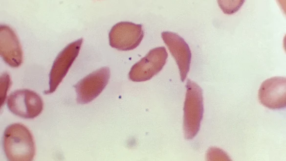Mikroskopbild zeigt halbmondf&ouml;rmige rote Blutk&ouml;rperchen eines an Sichelzellenan&auml;mie erkrankten Patienten aus dem Jahr 1972. - &copy; F. Gilbert/CDC/AP
