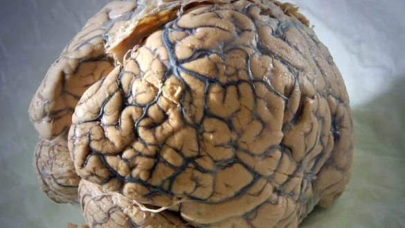 Ein Gehirn des Menschen in einem Labor der Klinik f&uuml;r Neurologie am Universit&auml;tsklinikum Jena. - &copy; Jan-Peter Kasper/dpa-Zentralbild/dpa