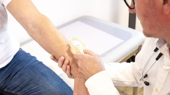 Hautscreening-Apps k&ouml;nnen die Krebsfr&uuml;herkennung beim Hautarzt nicht ersetzen. Aber: Viele Hautver&auml;nderungen beurteilen sie korrekt. - &copy; Benjamin Nolte/dpa-tmn