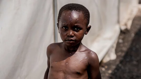 F&uuml;r Kinder und immungeschw&auml;chte Menschen kann die Krankheit t&ouml;dlich sein. (Archivbild) - &copy; Moses Sawasawa/AP/dpa