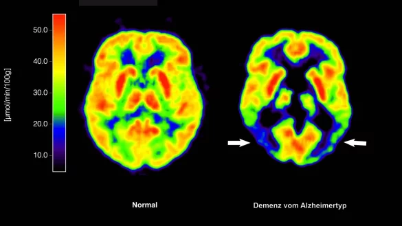 Haben die Amyloid-Plaques schon irreversible Sch&auml;den im Gehirn angerichtet, n&uuml;tzt ihre Entfernung nichts mehr. (Archivbild) - &copy; picture alliance / dpa