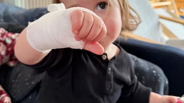 Verbrannt am hei&szlig;en Pfannenrand: Ein Wundverband sch&uuml;tzt die verletzte Stelle. - &copy; Till Simon Nagel/dpa-tmn