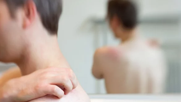 Hautbl&auml;schen und Juckreiz sind typische Symptome der G&uuml;rtelrose. - &copy; Friso Gentsch/dpa/dpa-tmn