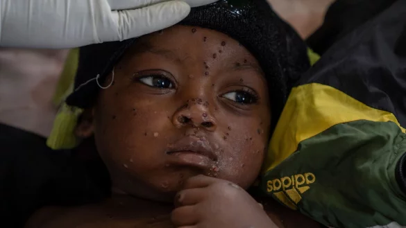 Neue Tests sollen die Ausbreitung von Mpox eind&auml;mmen helfen. (Archivbild) - &copy; Moses Sawasawa/AP/dpa