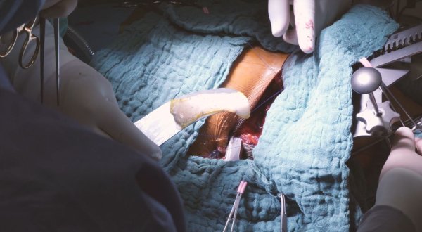 Bei einer Operation setzen Ärzte ein «Herzpflaster» ein. - © Universitätskrankenhaus Schleswig-Holstein/dpa