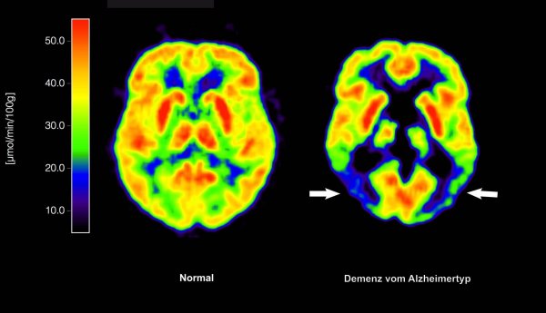 Lecanemab richtet sich gegen Amyloid-Ablagerungen im Gehirn und soll dadurch den Verlauf der Krankheit ein wenig verlangsamen. (Archivbild) - © Lutz Kracht/MPI/dpa