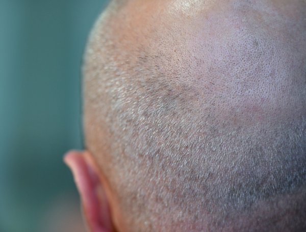 Mittel gegen Haarverlust gelten als sogenannte Lifestyle-Medikamente. - © Patrick Pleul/dpa/dpa-tmn