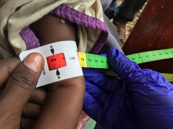 Der Armumfang eines schwer unterernährten Babys in Somalia wird gemessen. (Archivbild) - © Eva-Maria Krafczyk/dpa
