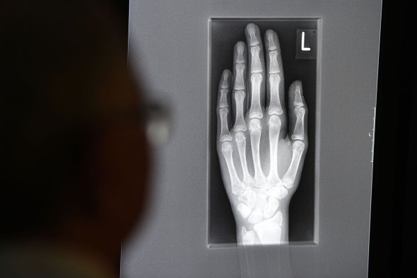 Ein Röntgenbild auf einem Bildschirm zeigt in einem Klinikum in Baden-Württemberg die linke Hand eines jungen Menschen im Alter zwischen 16 und 19 Jahren. - © Felix Kästle/dpa